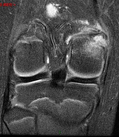 Figure 4 for case avulsion fracture MFC and tibial tubercle fx ( RID2896 ) ( RID4653 )